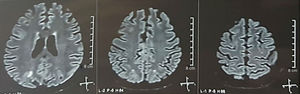 Simple+diffusion nuclear magnetic resonance imaging of the brain, of control (3 weeks later): previous lesions in resolution.