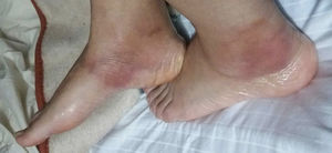 Flat, nodular, violaceous and indurated lesions, painful to palpation and of irregular surface, located in the inner portion of lower limbs associated with perimalleolar edema.