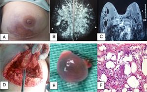 (A) Front view of the right breast. Note the atrophied skin and ulceration with exposure of the modeling agent. (B) Bilateral mammogram. (C) Nuclear magnetic resonance. (D and E) Transoperative images showing the pearls and pits developing in the breast tissue. (F) Hematoxylin–eosin stain.