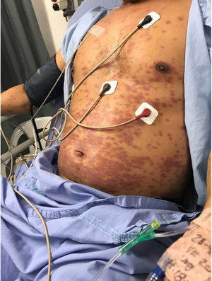 Maculopapular erythema of the chest, the abdomen and the extremities.