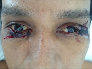 Patient with non-exudative bilateral conjunctivitis.