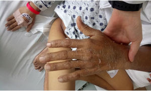 Desquamation of hands and fingertips (convalescent phase).