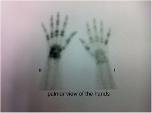 Bone scintigraphy of the hands with characteristic findings of psoriatic arthropathy2: asymmetric involvement, affection of distal interphalangeal joints and ray distribution (fifth finger of the left hand and third and fourth fingers of the right hand.).