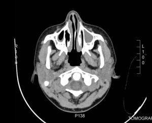 CT scan of paranasal sinuses.