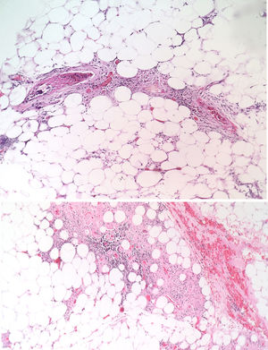H-E. 40X. Hypodermis with presence of thrombi in small and medium-caliber vessels. (Courtesy of Dr. María Janeth Vargas Manrique, Pathology Service, Central Military Hospital.)