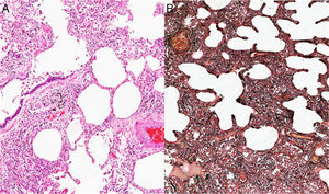 Biopsy of a pulmonary wedge. (A) H & E stain. (B) Russell-Movat Pentachrome. A histological pattern of nonspecific interstitial pneumonia predominantly of cellular subtype.
