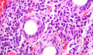 Biopsy of the salivary gland with H & E stain, 40×. A dense lymphoplasmocytic infiltrate is observed around the ducts, more than 5 foci of 50 periductal inflammatory cells, which are compatible with Sjögren's syndrome (Score 4.2, scale of Chisholm and Masson modified by Daniel and Whitcher).