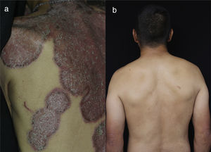 (a) On the dorsum presents erythematous, circumscribed, infiltrated plaques, with silvery scales, adherent and with raised edges with respect to the depressed center, (b) 10 years later there is an absence of cutaneous lesions.