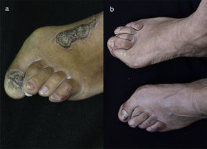 (a) In the left foot we can observe the nail of the thumb with subungual hyperkeratosis associated with onycholysis and yelowish chromonychia. In the nail of the third toe an oil drop spot is observed. Valgus deformity in the first and second toes. (b) 10 years later there is evidence of persistence of valgus deformity in the first toes of both feet, and also in the second toe of the left foot. Remarkable decrease in subungual hyperkeratosis, onycholysis and yellowish chromonychia is evident. Oil drop spots are no longer seen.