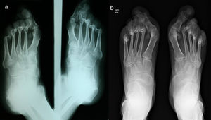 (a) Comparative foot X-ray, oblique projections: generalized diffuse osteopenia, degenerative changes of the metatarsophalangeal joints of all the toes with subluxation associated with valgus deformity, left calcaneal spur, mild degenerative changes of the joints of the forefoot with the midfoot. (b) Comparative foot X-ray, anteroposterior projections: generalized diffuse osteopenia, the changes described in the previous radiograph persist with progression thereof.