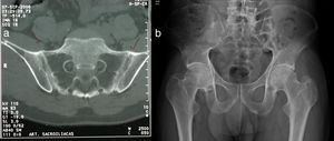 (a) CT scan of sacroiliac joints, axial section: fusion of the sacroiliac joints in the lower 2/3 due to bilateral ankylosis and bilateral sclerosis of the upper 1/3. (b) Hip X-ray, anteroposterior projection: complete fusion of sacroiliac joints, the coxofemoral joint relationships and in the pubic symphysis are preserved, decreased bone density.