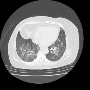 Chest tomography with contrast. There is a ground glass pattern with non-homogeneous distribution, with few centrilobular nodules, associated with traction, without formation of cavitations.