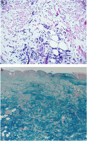 The histopathology with hematoxylin-eosin shows extensive deposits of mucin between the collagen bundles (a, magnification 10×). The colloidal iron staining shows deposits of mucin in the dermis and the hypodermis (b, magnification 10×).