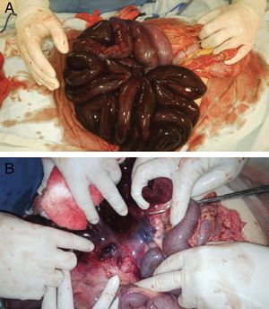 Intraoperative macroscopic findings of the patient, where necrosis of the small intestine (A) and formation of thrombus in the mesenteric vasculature are observed (B).