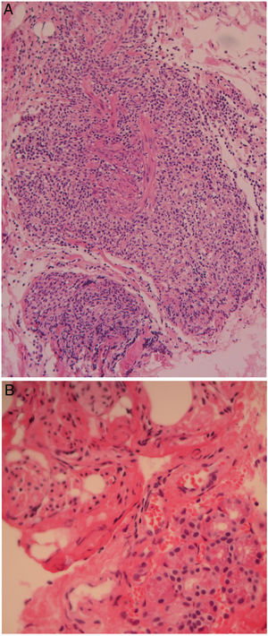 (A) Photomicrography of the upper rectus muscle at medium magnification showing a dense inflammatory infiltrate mixed with bundles of smooth muscle (H&E, original amplification 20×). (B) High magnification photomicrography of the main lacrimal gland showing few acini and some bundles of smooth muscle “Müller's muscle” (H&E, original amplification 40×).