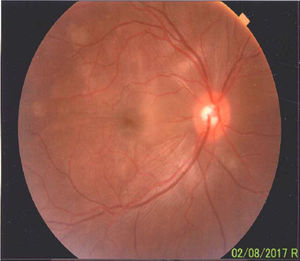 A preserved artery-vein ratio, disc with well-defined borders, yellow-pink, excavation 0.4, normal vascular emergence and distribution can be observed in the eye fundus. The posterior pole, macular area and peridiscal region show folds in the internal limiting membrane and diffuse defects of the yellow in patches.