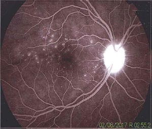 The angiography showed adequate circulatory dynamics of the medium with hyperfluorescence of the disc. Multiple hyperfluorescent defects due to dye leakage, suggestive of serous retinal detachments can be observed in the photo of the posterior pole. Punctiform hyperfluorescent defects are also shown in the macular area.