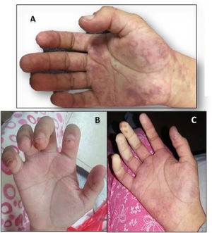 Right hand. (A) Livedo reticularis. (B) Trophic changes in fingertips. (C) Decreased distal perfusion with predominance of the ulnar artery.