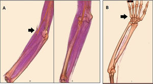 (A) Angio-MSCT of the right arm, showing flow obstruction of the radial and ulnar arteries, and mild flow of the interosseous artery. (B) Absent flow in the palmar arch.