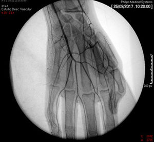Peripheral arteriography with comparative selective catheterization of the upper extremities. Following balloon dilation angioplasty in the right arm, there is evidence of blood flow into the palmar arch.