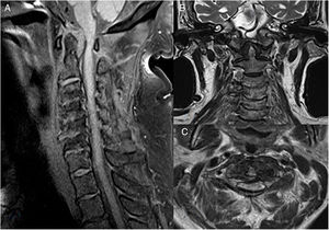 Cervical spine MRI. (A) Sagittal T1 with axial fat saturation. (B) Coronal T2. (C) Axial T2.