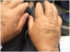 Illustrates bilateral oedema with fovea on the dorsum of hands, predominantly affecting the extensor tendons.