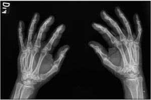 Indicates synovitis in the proximal interphalangeal joints, without dactylitis.