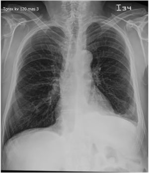 AP view of the chest with signs suggestive of growth of the right cardiac chambers and signs of precapillary hypertension, prominent pulmonary artery trunk. Thickening of the diaphragmatic and lower left costal pleura, sparse ipsilateral pleural effusion.