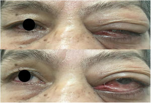 The left eye has a significant proptosis and blepharoptosis, with a space-occupying lesion in the upper half of the left orbit, conjunctival hyperaemia, conjunctivochalasis, mucoserous secretion.
