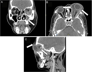 CT-scan of the face: (A) the left maxillary sinus is completely occupied, with soft tissue density associated with thickening of the adjacent bone cortex, relating to chronic inflammatory changes. (B and C) Diffuse alteration of the left periorbital soft tissues, with heterogeneous density enhancement of the pre and post-septal segment, with extension into the soft intra and extraconal tissues, promoting secondary proptosis without developing a definite mass; such inflammatory changes extend into the supraorbital, palpebral and malar region, with no evidence of organized fluid collections.