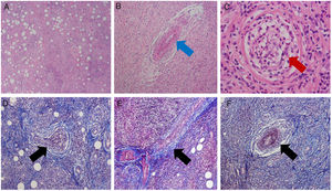 Histopathological study. Upper: H&E stain. Lower: Masson trichrome stain. (A) General view: connective and adipose tissue with abundant acute and chronic inflammatory infiltrate (lymphocytes and polymorphic nuclear neutrophils) forming stem centers, with con eosinophilia and focal necrosis. (B–F) Granulomatous reaction with giant cells and the presence of vasculitis of the muscle arteriolar vessels (red arrow) and venules (blue arrow), due to hyperplasia of the vascular walls, vascular occlusion and fibrinoid necrosis (black arrow).