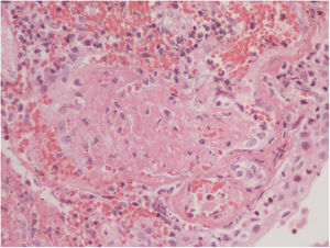 Vasculitis and necrosis H&E 10×. Bladder wall with partial necrosis of the blood vessel walls, hemorrhage, vascular wall inflammation, loss of the urothelial coating and extensive wall bleeding.
