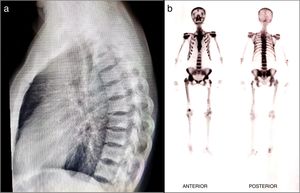 (a) X-rays: spinal osteoblastic lesions. (b) Bone scan: increased uptake lesions mostly in the axial skeleton, shoulders and pelvis of a patient with polyostotic PD III.