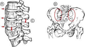 Resnick-Niwayama radiological criteria: A: ossification of the anterior longitudinal ligament in at least 4 continuous vertebrae; B: preservation of the intervertebral space; C: preservation of the facet joint; D: absence of sacroiliac joint involvement.