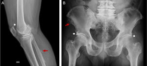 65-year old male, obese, with a history of 15 years of evolution of pain in the dorsolumbar spine and knees associated with right lower extremity paresthesia. Radiographic findings (A) right knee, bone excrescences in the patella (*) and in the fibular enthesis (red arrow), (B) ossification in enthesis of the iliac spines (red arrow) and the acetabulum. (*).