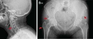 71-year old woman, diabetic, with 4 years of evolution of cervical-dorsal pain and limitation. Radiographic findings (A) cervical, bone bridges C2-C7 (red arrow), (B) pelvic, bone excrescences in enthesis of the iliac spine, acetabulum and femoral greater trochanter (red arrow).