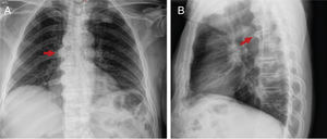 73-year old male with one and half years of evolution of cervicodorsal pain and limitation. Radiographic findings (A) PA view of the chest, predominantly right bone bridges (red arrow); (B) lateral view, bone bridges T2-T8 (red arrow).