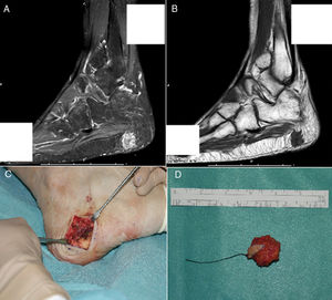 A) MRI showing a polylobulated lesion of approximately 17×14mm, contrast enhanced in the STIR sequence. B) Hypointense in T1, localized inside the subcutaneous fat of the posterior plantar region, with no clear dependency of the plantar fascia. C) Cross-section incision in the right lateral plantar region during surgery. D) Macroscopic aspect of the encapsulated tumor excised with free margins.