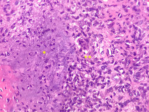 Phosphaturic mesenchymal tumor showing spindle cell proliferation with poorly defined (blurred) calcified matrix production (*), with osteoclast-type giant cells (**). Hematoxylin – eosin stain (20×).