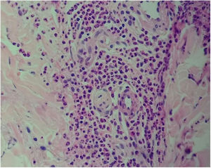 Leucocytoclastic vasculitis: fibrin in wall vessel and neutrophilic nuclear dust. 200× hematoxilin–eosin.