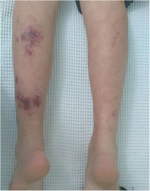 Cutaneous necrosis in lower limbs.