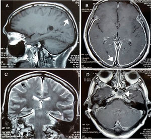 (A) Pachymeningeal thickening in non-contrast MRI (B and C) Diffuse enhancement dural thickening in cerebral convexity and cerebellar tentorium consistent with pachymeninigitis in T1- and T2-weighted MRI (arrows). (D) Axial MRI shows right otomastoiditis and left sphenoid sinusitis (arrows).