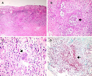 (A) H&E stain. Thickened dura mater with extensive lymphoplasmacytic infiltrate. (A–C) Granulomatous areas with microabcesses, necrosis and multinucleated giant cells (Langhans-type). (D) Masson's trichrome stain shows inflammatory infiltrate in smooth muscle vessel wall (red) with surrounding fibrotic areas (blue).