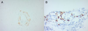 Immunohistochemistry in biopsy samples of two patients with PACNS. (A) Leukocytic infiltrates mostly of T lymphocytes (CD3+) with higher prevalence of CD4+ cells. (B) HLA expression in PACNS (50% of the cells).