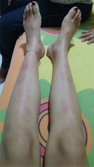Purplish erythematous nodes in the lower extremities, with erythema nodosum.