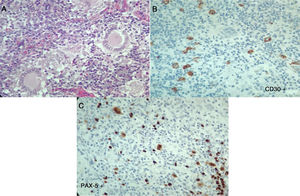 Second histopathology of the cervical lymph node, Case 2. A) Lymph node with abnormal architecture, large, lobulated, binucleated and mononucleated cells, with prominent nucleolus, multinucleated giant cells. Additionally, fibrosis and stroma collagen formation are present. B and C) The neoplastic cells described express CD30, CD15, MUM-1, PAX-5 and latent membrane protein 1 (LMP-1). The lymphoid population is mostly helper T-cells CD3, CD4, CD2, CD7, CD5, with few CD8. Compatible with classical Hodgkin lymphoma, nodular sclerosis.