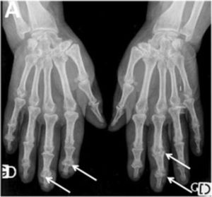 Erosive radiographic arthritis characterized by erosions and joint space narrowing involving the PIP and DIP joints (arrows). Adapted (with permission) from: Avouac et al.1