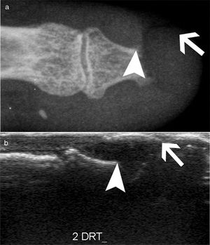 Acroosteolysis of the index finger in a SSc patient. a. plain radiograph imaging. b. ultrasonography imaging. Adapted (with permission) from: Freire et al.73