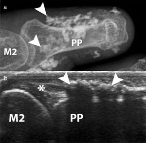 Calcinosis of the index finger in a SSc patient. a. plain radiograph imaging. b. ultrasonography imaging. Adapted (with permission) from: Freire et al.73