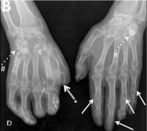 Typical hand findings in simple radiography of a patient with SSc. (white arrow: yuxta articular erosions with joint space loss, asterix: acroosteolysis, hash: calcinosis). Adapted (with permission) from: Avouac et al.1